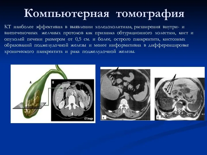 Компьютерная томография КТ наиболее эффективна в выявлении холедохолитиаза, расширения внутри- и внепеченочных