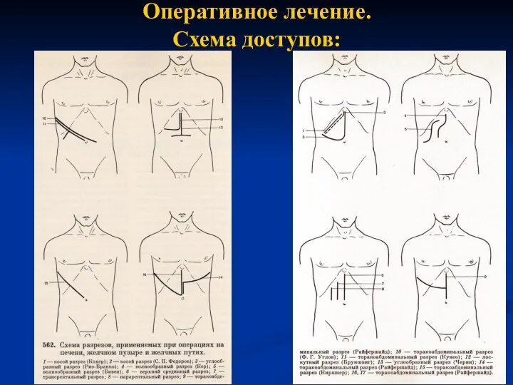 Оперативное лечение. Схема доступов: