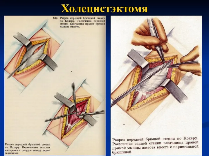 Холецистэктомя