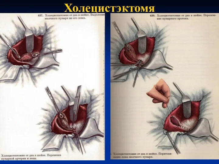 Холецистэктомя