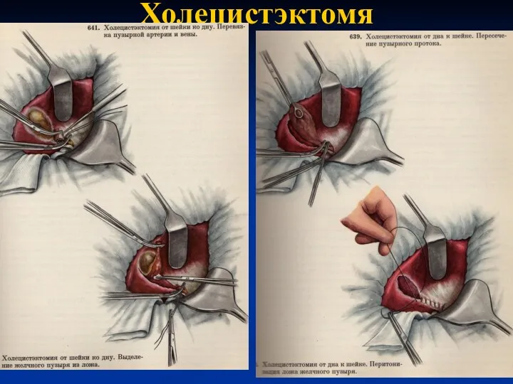 Холецистэктомя