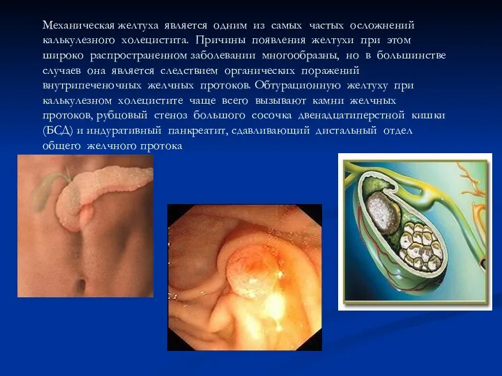 Механическая желтуха является одним из самых частых осложнений калькулезного холецистита. Причины появления