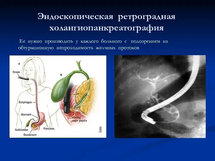 Эндоскопическая ретроградная холангиопанкреатография Ее нужно производить у каждого больного с подозрением на обтурационную непроходимость желчных протоков