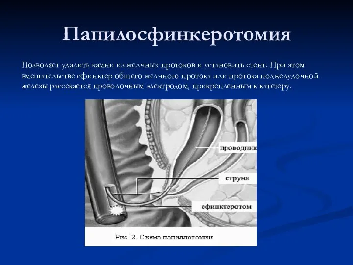 Папилосфинкеротомия Позволяет удалить камни из желчных протоков и установить стент. При этом