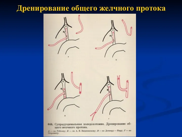 Дренирование общего желчного протока