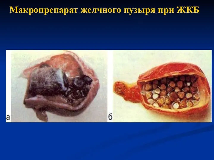 Макропрепарат желчного пузыря при ЖКБ