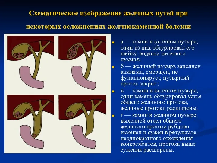 Схематическое изображение желчных путей при некоторых осложнениях желчнокаменной болезни а — камни