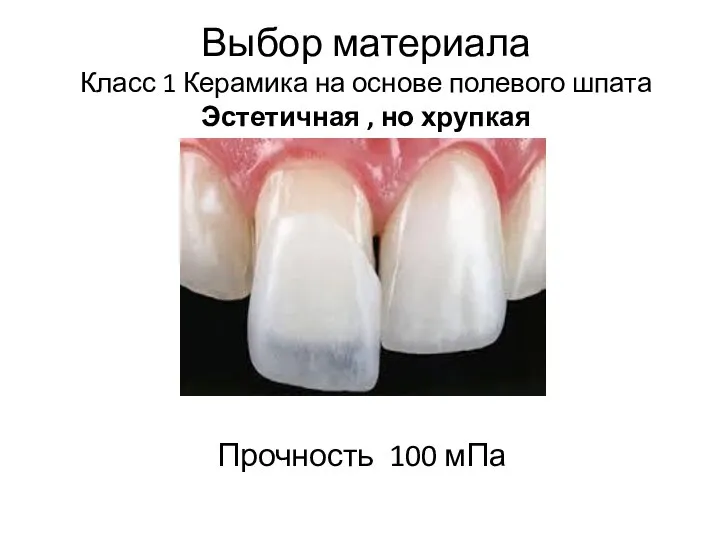 Выбор материала Класс 1 Керамика на основе полевого шпата Эстетичная , но хрупкая Прочность 100 мПа