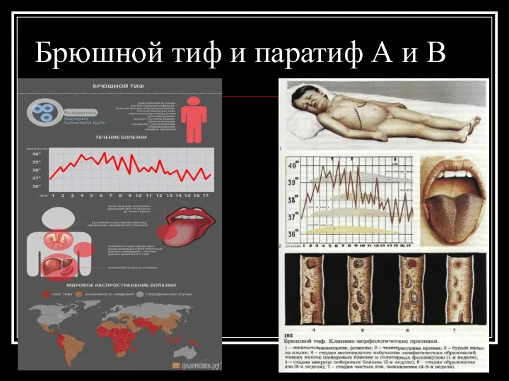 Брюшной тиф и паратиф А и В