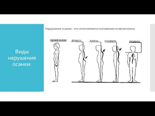 Виды нарушения осанки: Нарушение осанки - это отклонения в положении позвоночника.