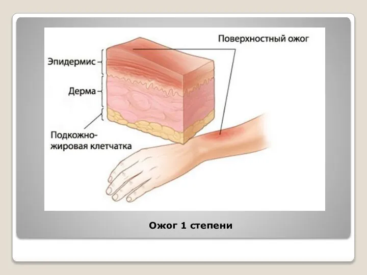 Ожог 1 степени