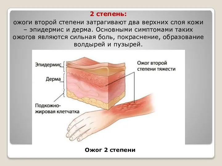 2 степень: ожоги второй степени затрагивают два верхних слоя кожи – эпидермис