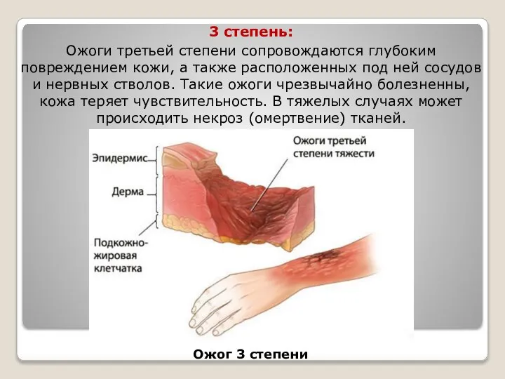 3 степень: Ожоги третьей степени сопровождаются глубоким повреждением кожи, а также расположенных