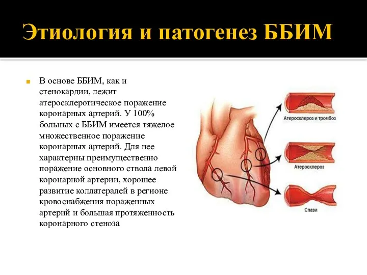 Этиология и патогенез ББИМ В основе ББИМ, как и стенокардии, лежит атеросклеротическое