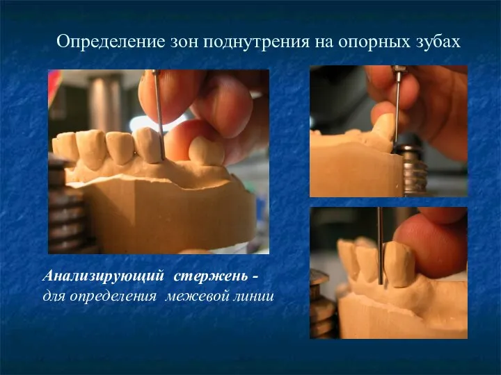 Определение зон поднутрения на опорных зубах Анализирующий стержень - для определения межевой линии