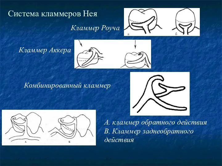 Система кламмеров Нея Кламмер Роуча Кламмер Аккера Комбинированный кламмер А. кламмер обратного