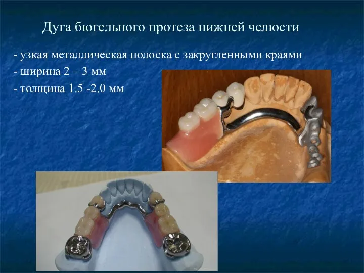 Дуга бюгельного протеза нижней челюсти - узкая металлическая полоска с закругленными краями