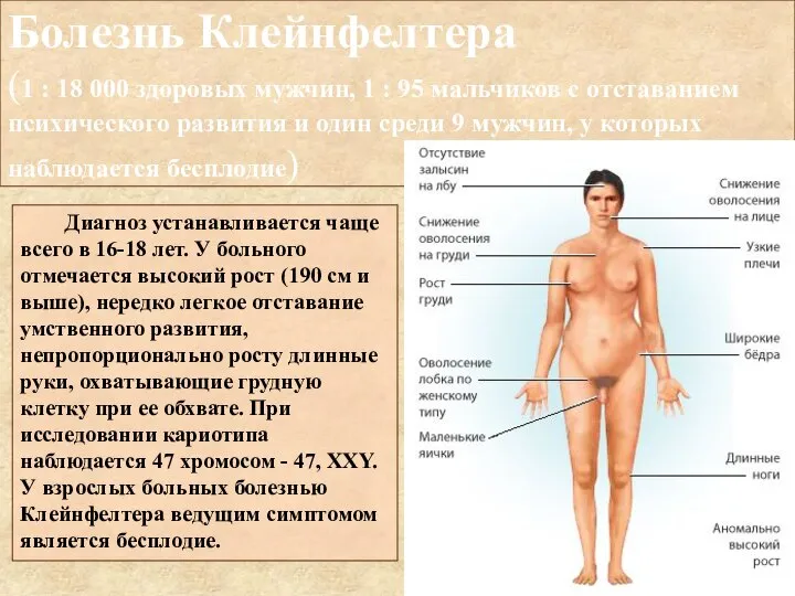 Болезнь Клейнфелтера (1 : 18 000 здоровых мужчин, 1 : 95 мальчиков