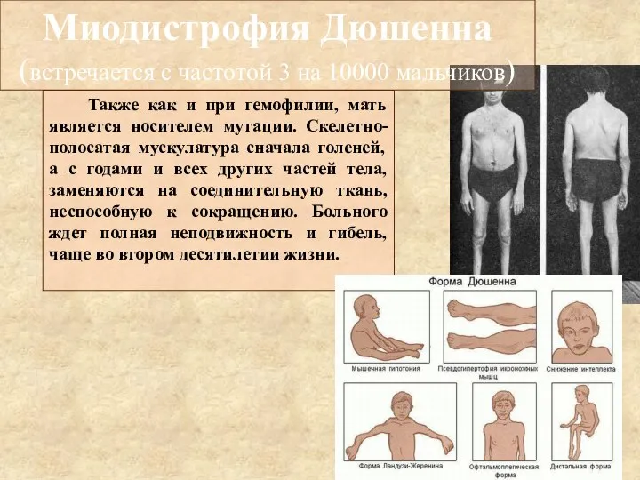 Миодистрофия Дюшенна (встречается с частотой 3 на 10000 мальчиков) Также как и