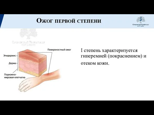 Ожог первой степени I степень характеризуется гиперемией (покраснением) и отеком кожи.