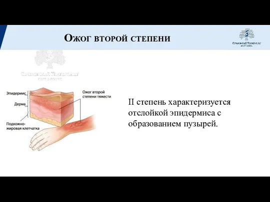 Ожог второй степени II степень характеризуется отслойкой эпидермиса с образованием пузырей.