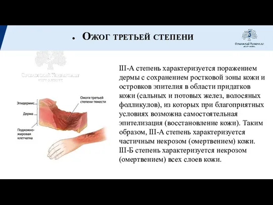 Ожог третьей степени III-A степень характеризуется поражением дермы с сохранением ростковой зоны