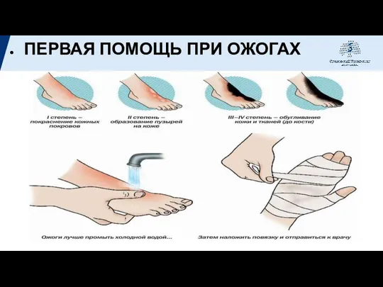 ПЕРВАЯ ПОМОЩЬ ПРИ ОЖОГАХ