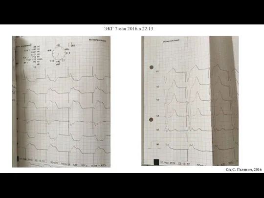 ЭКГ ©А.С. Галявич, 2016 ЭКГ 7 мая 2016 в 22.13