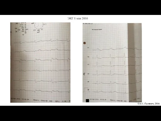 ©А.С. Галявич, 2016 ЭКГ 8 мая 2016