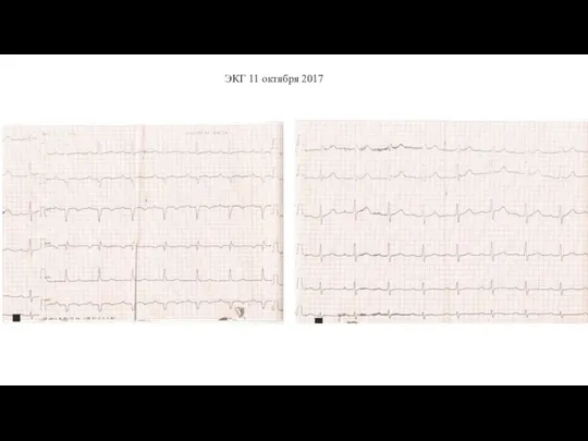 ЭКГ 11 октября 2017
