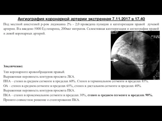 Ангиография коронарной артерии экстренная 7.11.2017 в 17.40 Под местной анестезией р-ром лидокаина