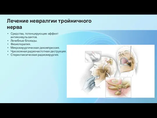 Лечение невралгии тройничного нерва Средства, потенцирующие эффект антиконвульсантов. Лечебные блокады. Физиотерапия. Микрохирургическая