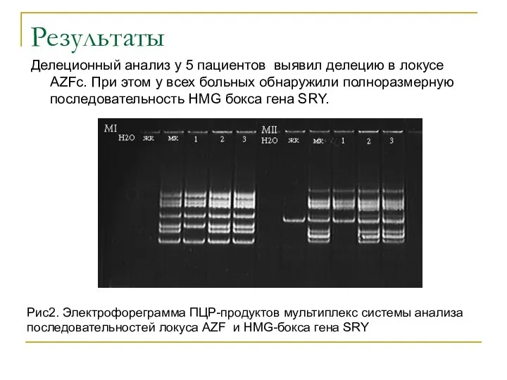 Результаты Делеционный анализ у 5 пациентов выявил делецию в локусе AZFc. При