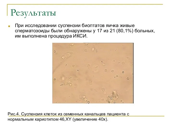 Результаты При исследовании суспензии биоптатов яичка живые сперматозоиды были обнаружены у 17