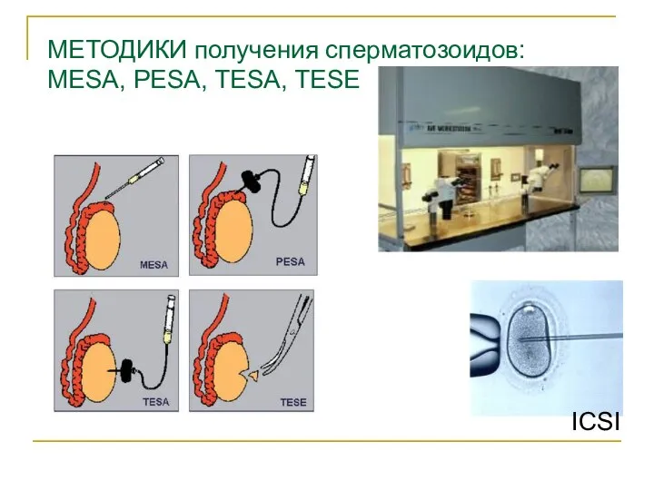 ICSI МЕТОДИКИ получения сперматозоидов: MESA, PESA, TESA, TESE