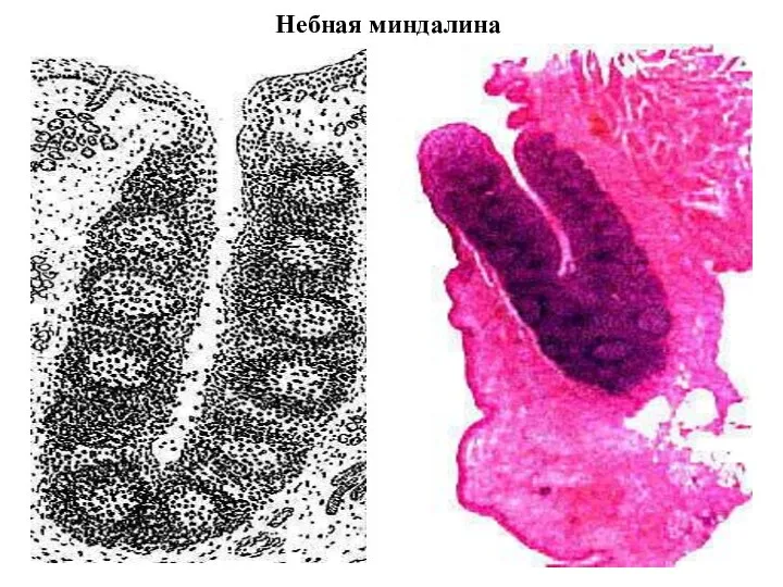 Небная миндалина