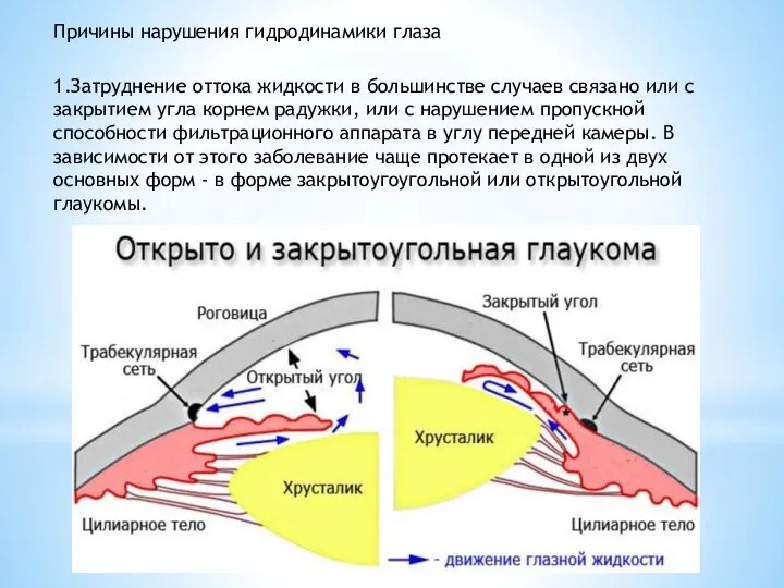 Причины нарушения гидродинамики глаза 1.Затруднение оттока жидкости в большинстве случаев связано или