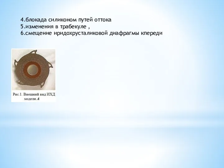 4.блокада силиконом путей оттока 5.изменения в трабекуле , 6.смещение иридохрусталиковой диафрагмы кпереди