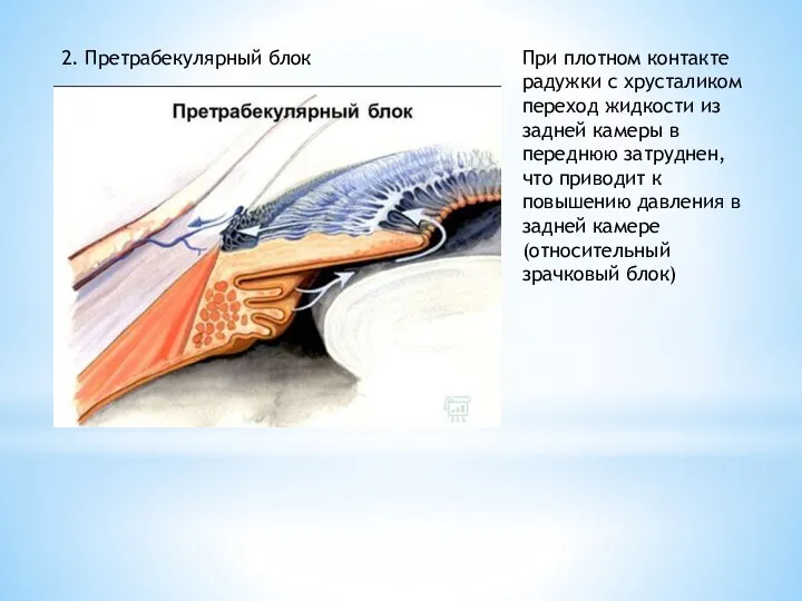 2. Претрабекулярный блок При плотном контакте радужки с хрусталиком переход жидкости из