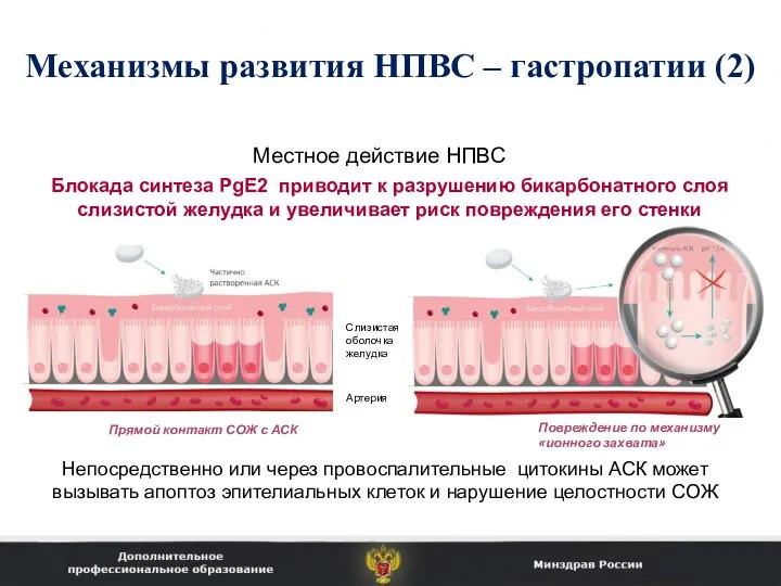 Механизмы развития НПВС – гастропатии (2) Местное действие НПВС Непосредственно или через