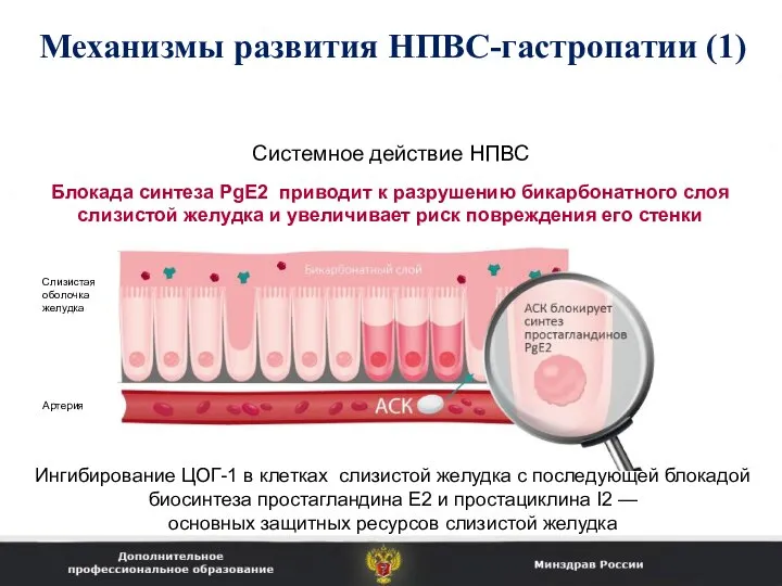 Механизмы развития НПВС-гастропатии (1) Системное действие НПВС Слизистая оболочка желудка Артерия Ингибирование