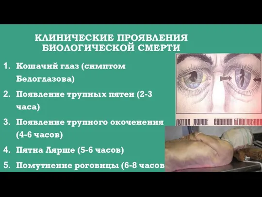КЛИНИЧЕСКИЕ ПРОЯВЛЕНИЯ БИОЛОГИЧЕСКОЙ СМЕРТИ Кошачий глаз (симптом Белоглазова) Появление трупных пятен (2-3
