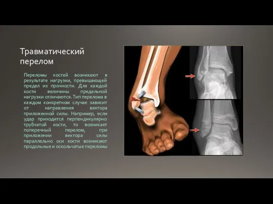 Травматический перелом Переломы костей возникают в результате нагрузки, превышающей предел их прочности.