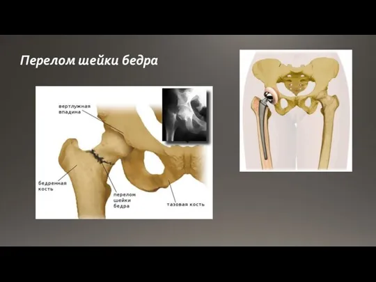 Перелом шейки бедра