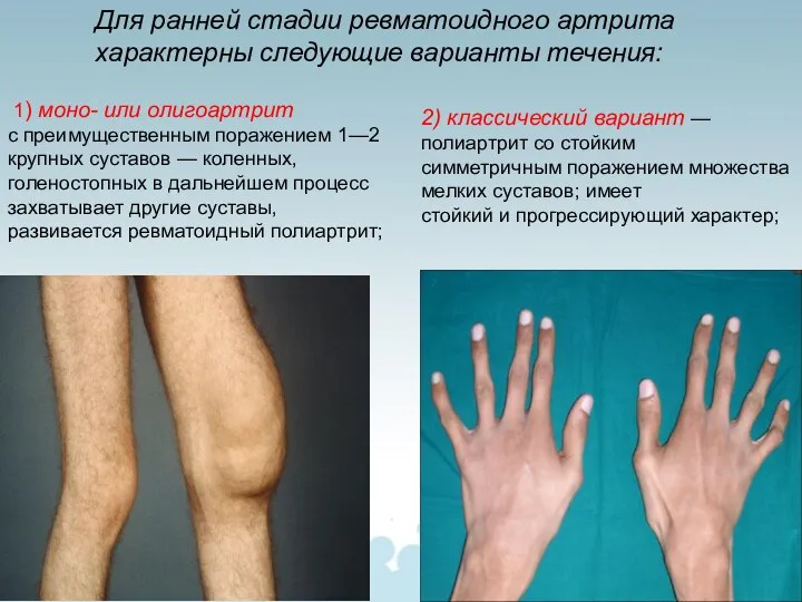 1) моно- или олигоартрит с преимущественным поражением 1—2 крупных суставов — коленных,