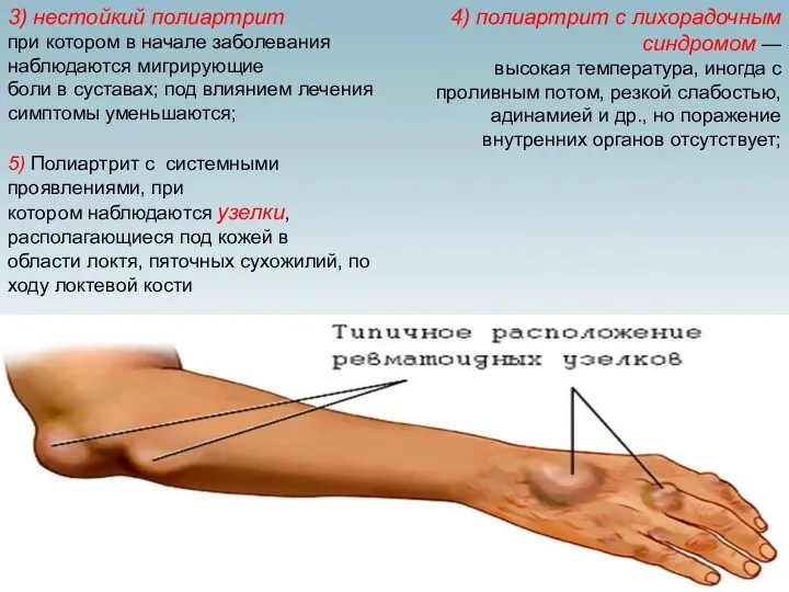 3) нестойкий полиартрит при котором в начале заболевания наблюдаются мигрирующие боли в