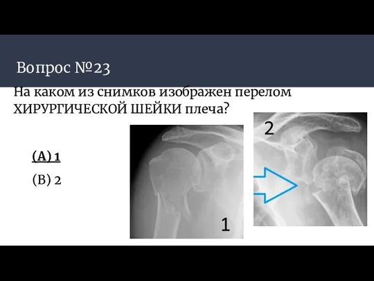 Вопрос №23 На каком из снимков изображен перелом ХИРУРГИЧЕСКОЙ ШЕЙКИ плеча? (A) 1 (B) 2