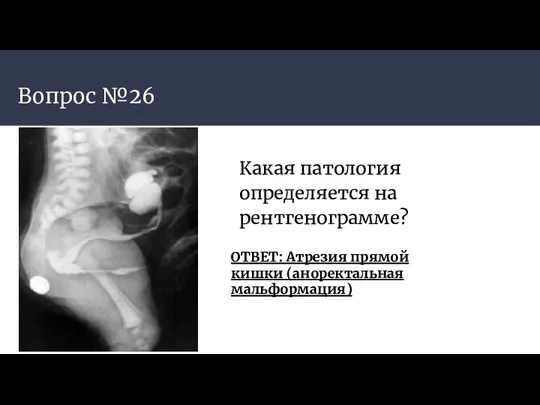 Вопрос №26 Какая патология определяется на рентгенограмме? ОТВЕТ: Атрезия прямой кишки (аноректальная мальформация)