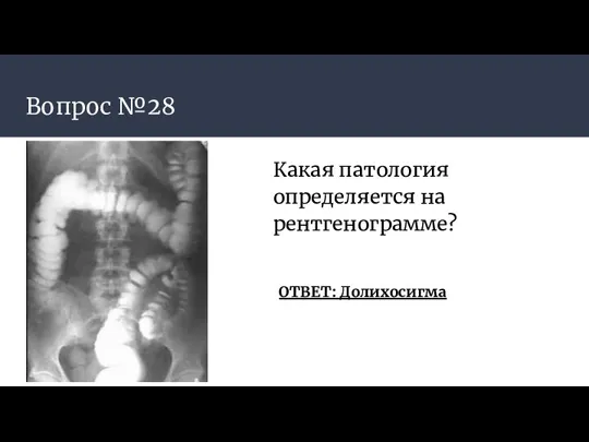 Вопрос №28 Какая патология определяется на рентгенограмме? ОТВЕТ: Долихосигма