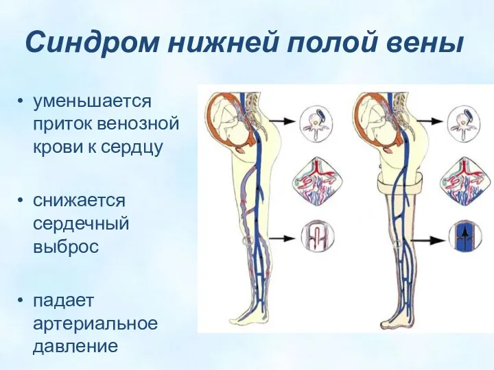 Синдром нижней полой вены уменьшается приток венозной крови к сердцу снижается сердечный выброс падает артериальное давление